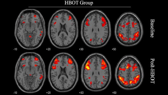 צילום MRI פונקציונלי לפני ואחרי טיפול (צילום: המרכז הרפואי שמיר)
