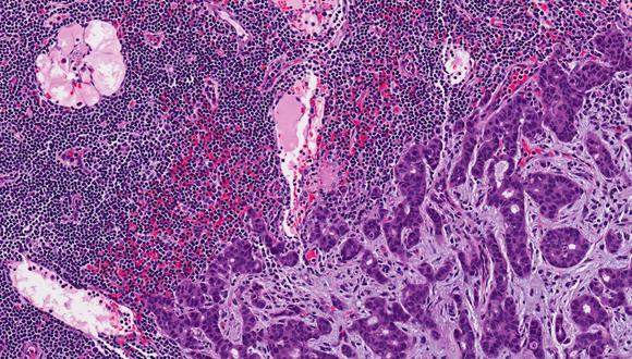 שיטה חדשנית המונעת את תנועתם של תאים ממאירים מסרטן השד שיטה חדשנית המונעת את תנועתם של תאים ממאירים מסרטן השד