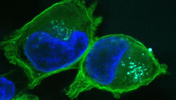 פריצת דרך במאבק בסרטן הלבלב פריצת דרך במאבק בסרטן הלבלב